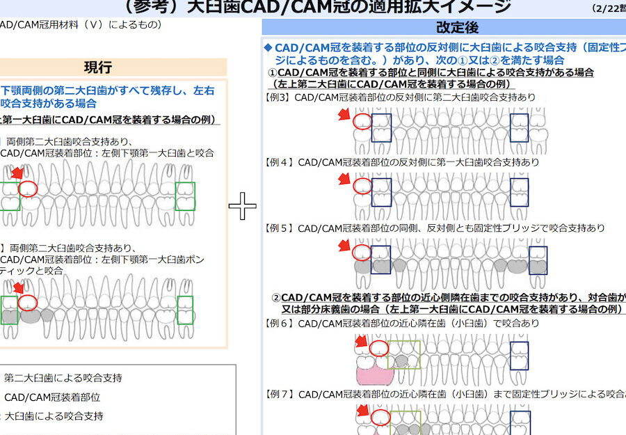 セラミック保険適用はいつから始まるのか解説
